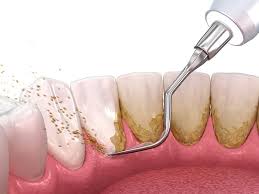 Cleaning Teeth